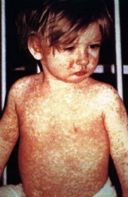 A toddler exhibits the classic measles rash.